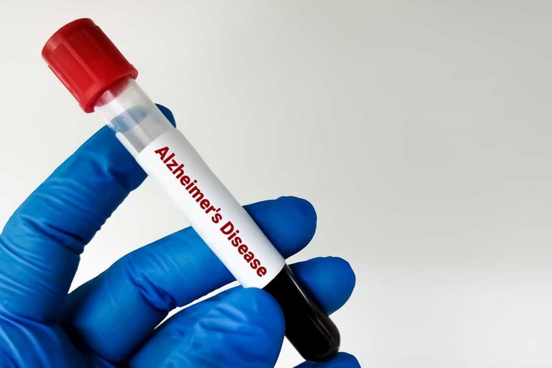 Novo teste de sangue pode prever Alzheimer até 20 anos antes dos sintomas