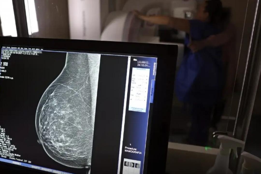 Periodicidade de mamografias divide médicos e autoridades de saúde