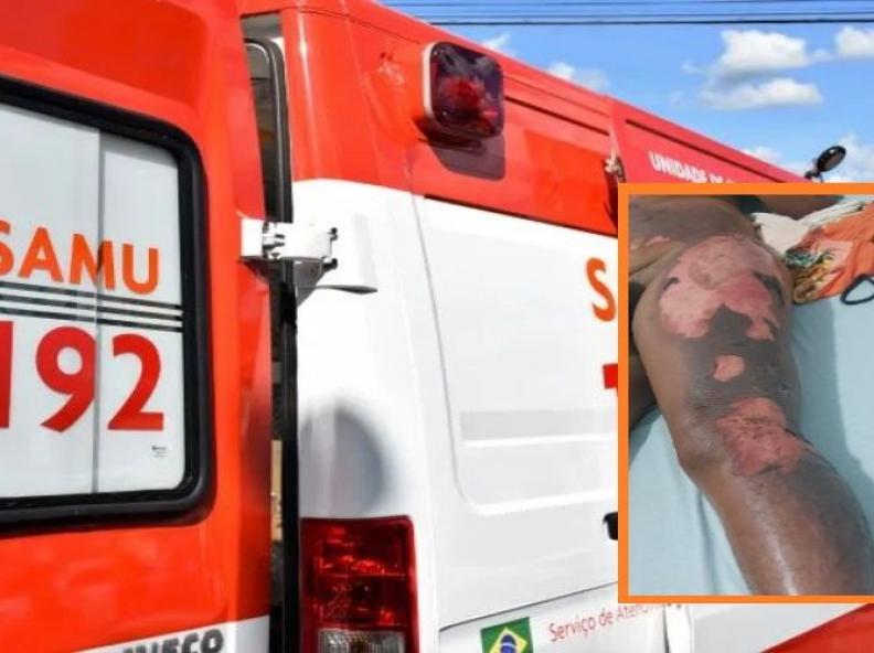 Homem joga água quente na esposa que dormia; vítima sofreu queimaduras de 2º grau