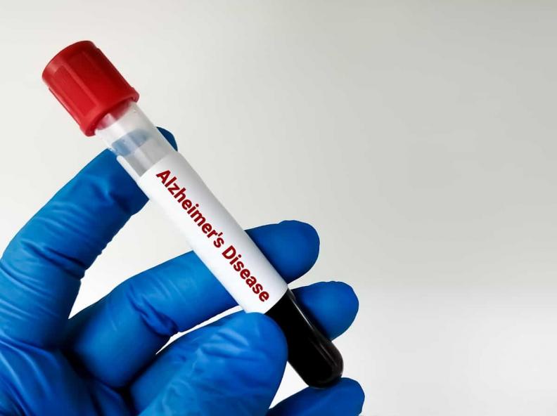 Novo teste de sangue pode prever Alzheimer até 20 anos antes dos sintomas