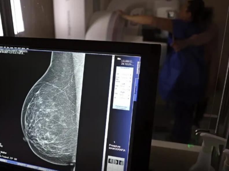 Periodicidade de mamografias divide médicos e autoridades de saúde